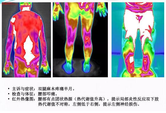 红外热成像扫描（GTT）中腰椎热图